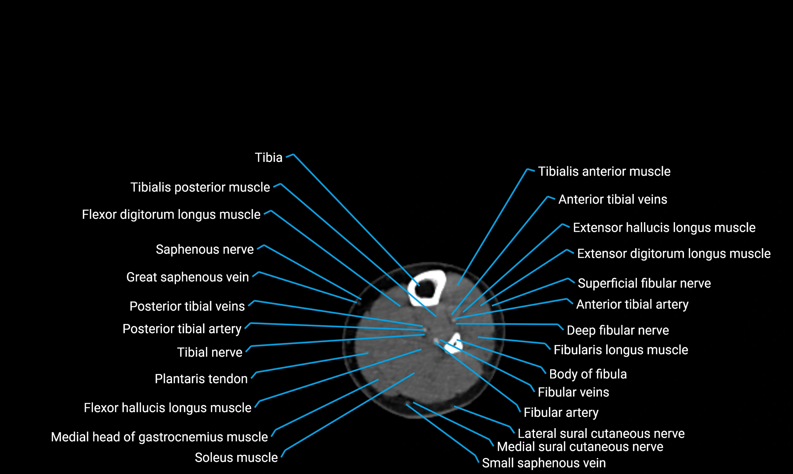 CT lower limb axial cross sectional anatomy labelled image 118 (2).webp